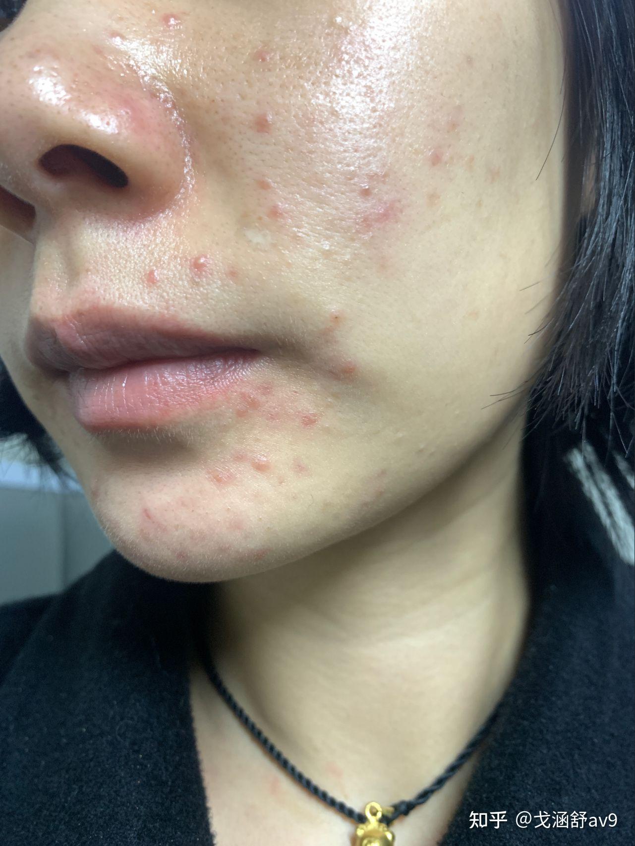 脸上有痘印怎么办保姆级教程轻松去除脸上痘印