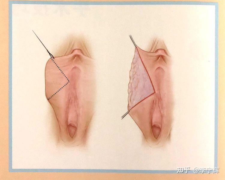 对小阴唇形态上的考虑,通常也会将皮肤面的组织要比黏膜面保留多一点