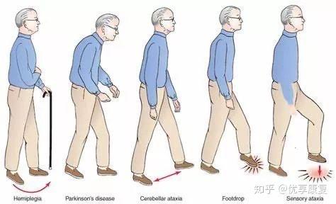 常见的异常步态 - 知乎