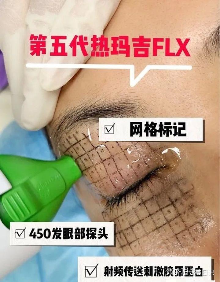 眼部热玛吉热玛吉是非侵入式无创的紧致肌肤,除皱的美容设备.