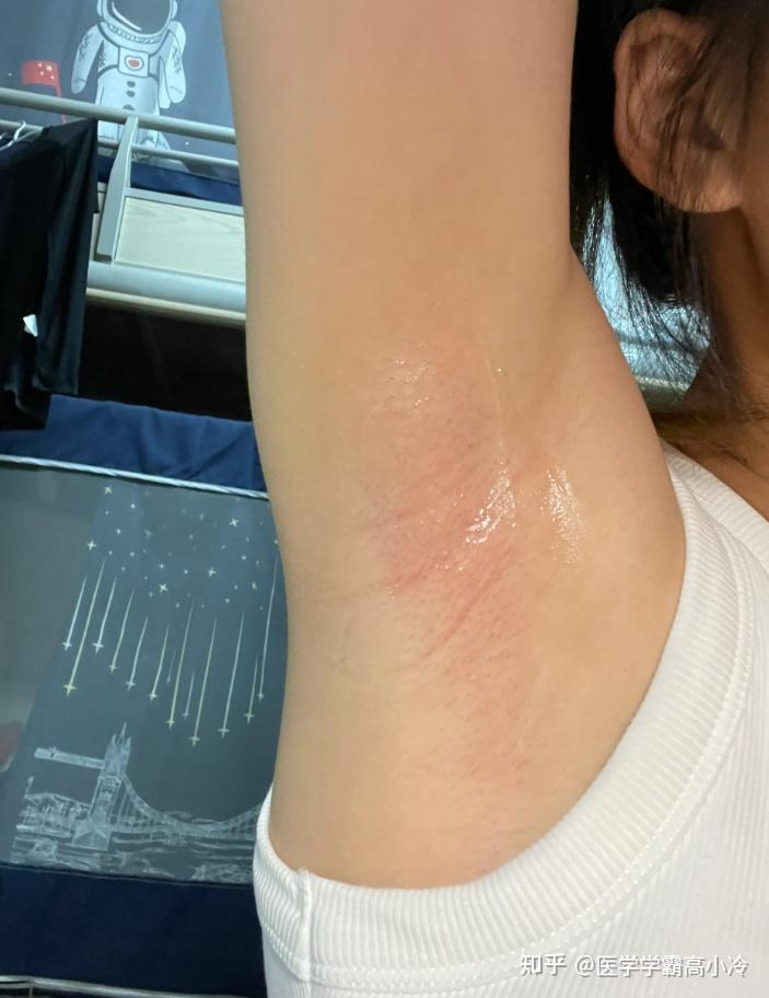 快速低成本脱毛指南脱毛哪有这么难专业医学生分享给你这篇脱毛指南