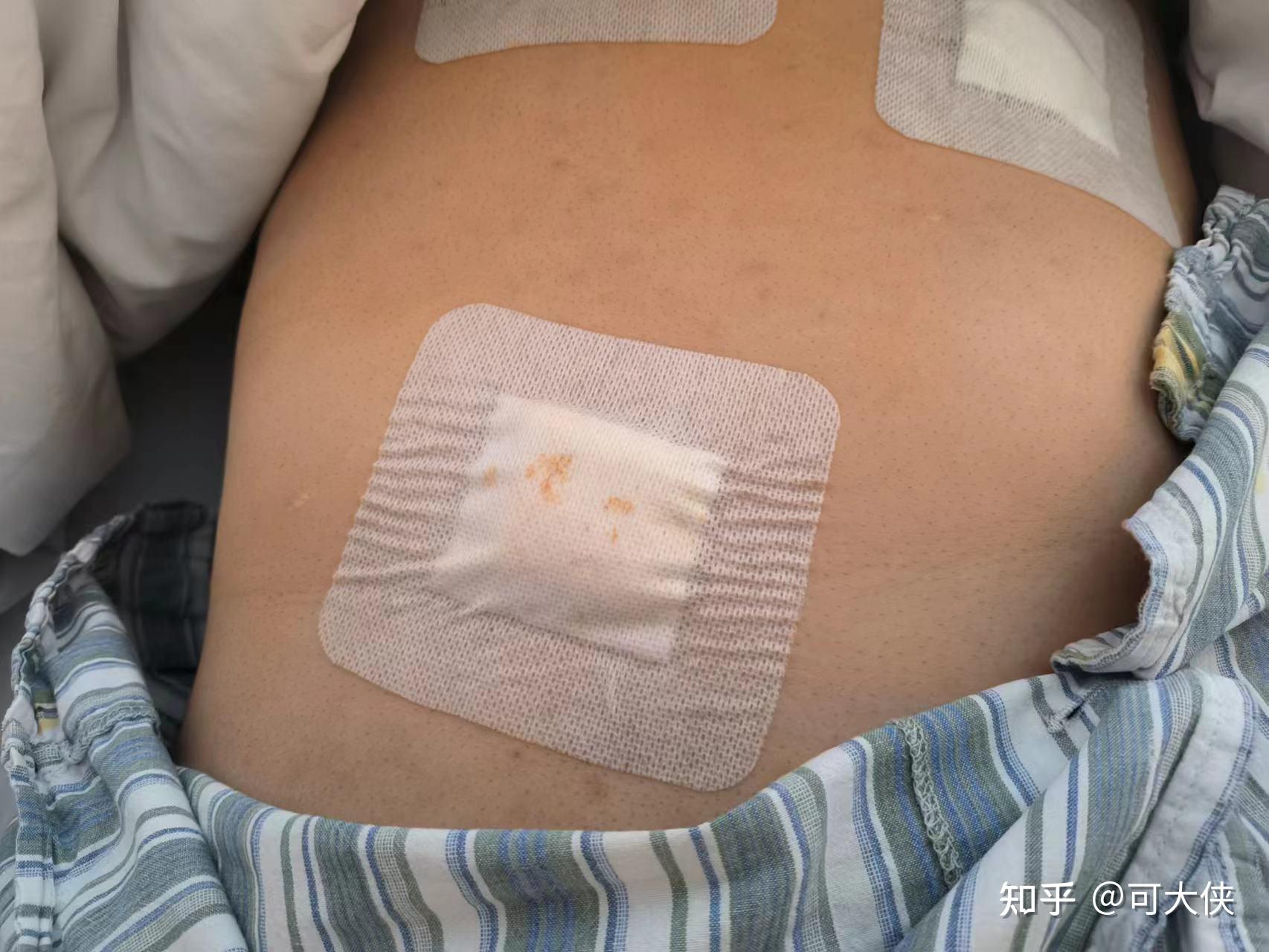记录我胆囊切除手术的全过程
