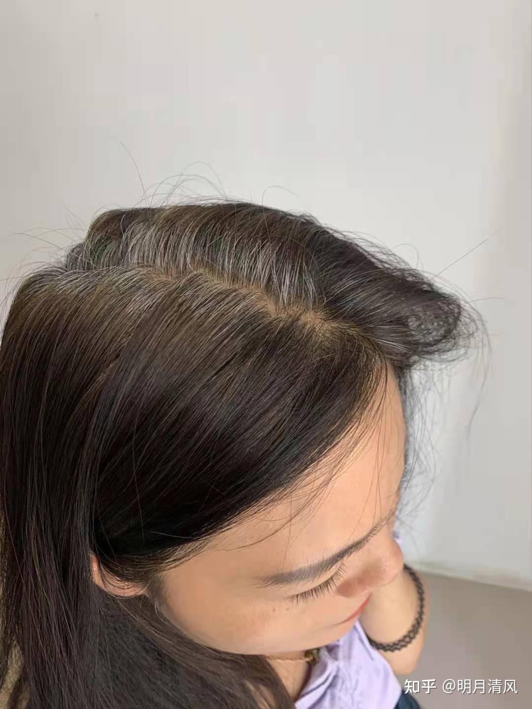 很快就有了效果,起初不太敢相信,后来发现自己白了的头发竟然开始变黑