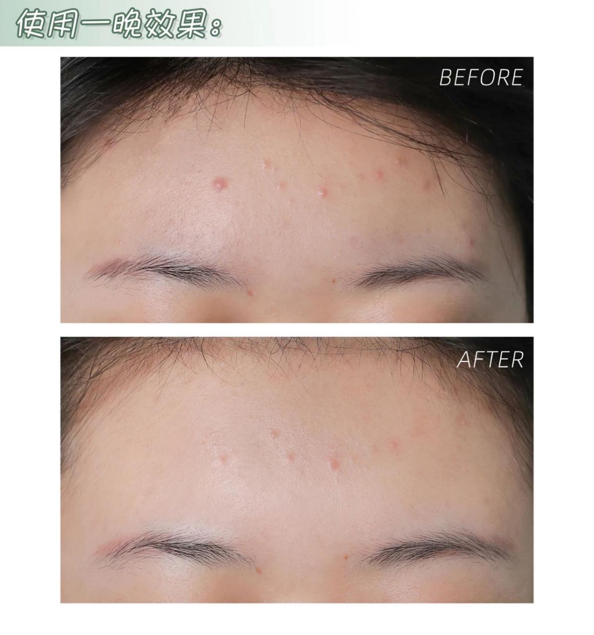 针清是家常便饭