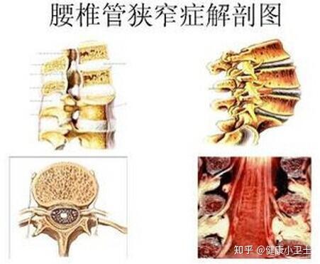 临床上腰椎管狭窄的三种类型是什么 知乎