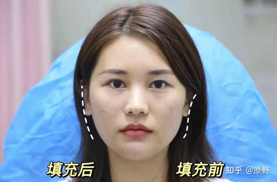 如何判断自己的面部凹陷类型