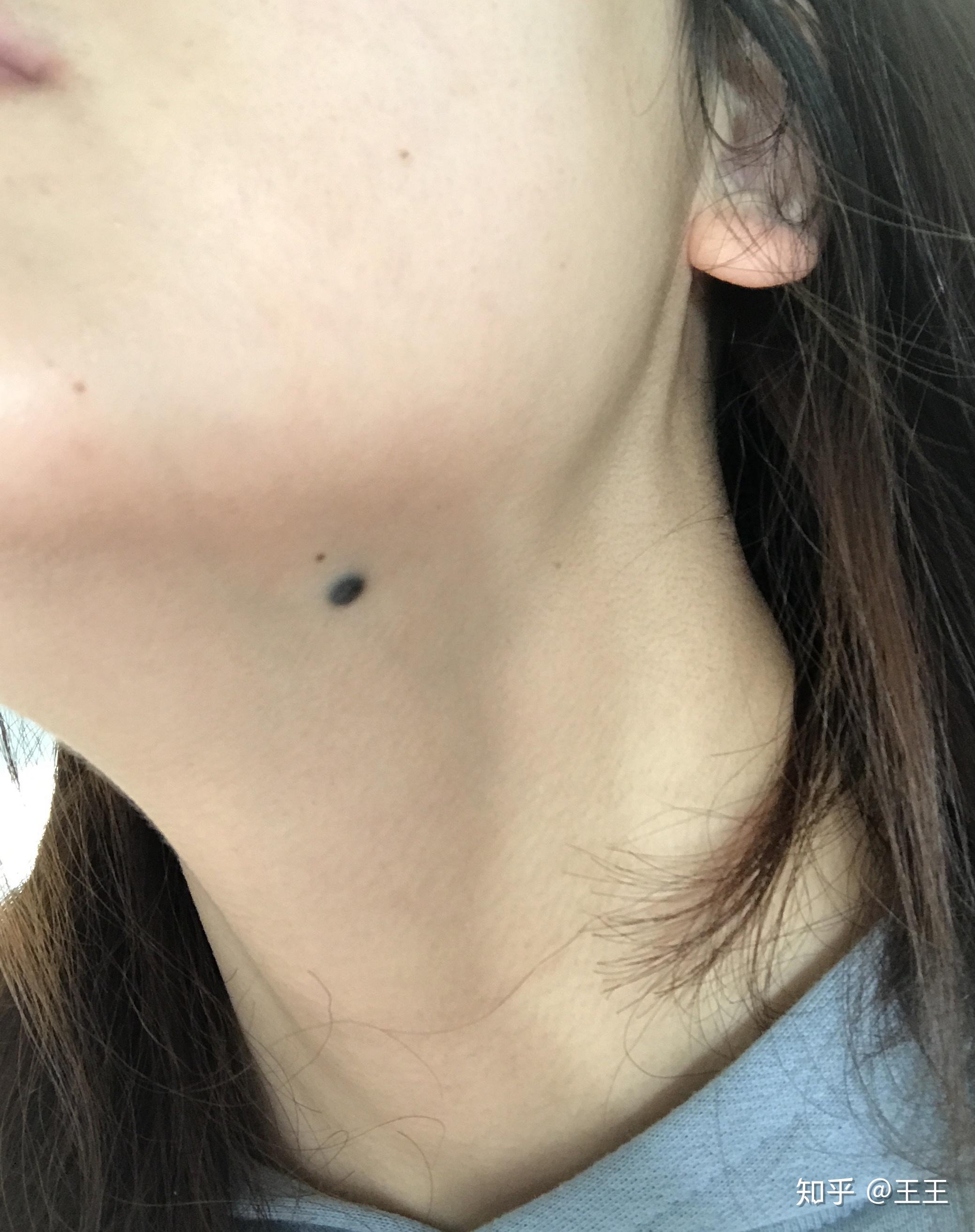 蓝痣手术切除记录 - 知乎