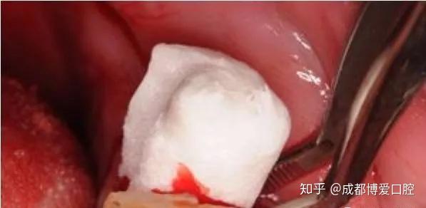 拔牙打麻药对大脑有影响吗会不会变笨