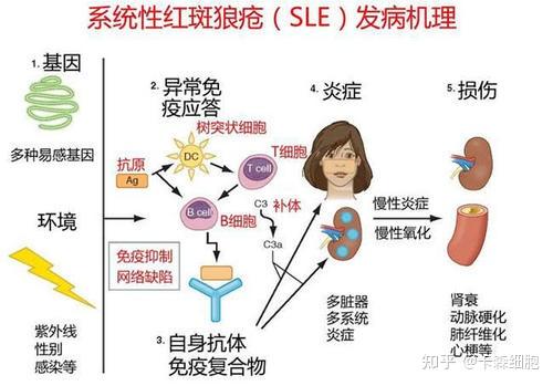 脐带间充质干细胞治疗系统性红斑狼疮