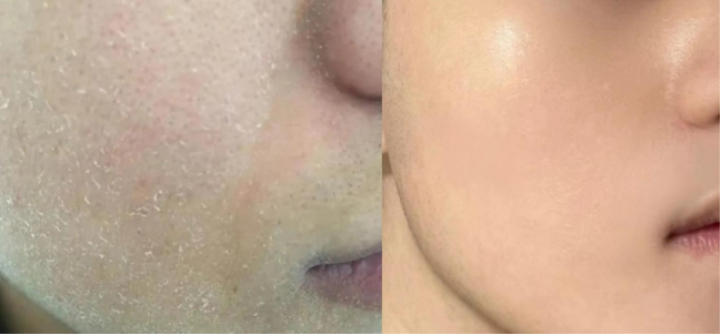 男士脸干燥起皮应该怎么办?