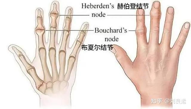 手指关节痛,是什么原因?