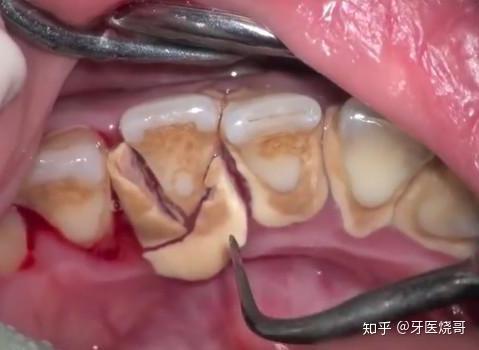 牙结石除了洗牙 还有什么办法可以让牙结石脱落 知乎