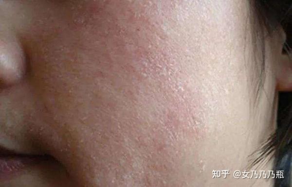 从干性皮肤说起,干性皮肤最大的苦恼就是,化妆起皮,卡粉,易起皱纹.