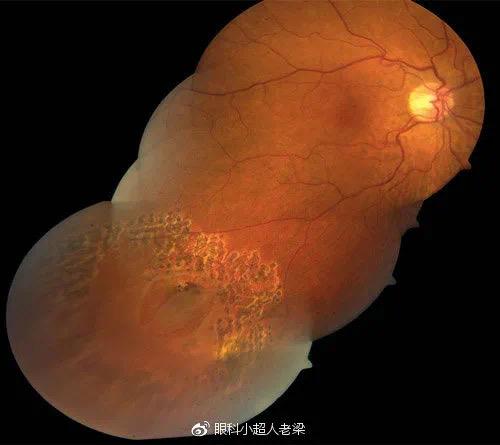 近视人群如何预防视网膜脱落