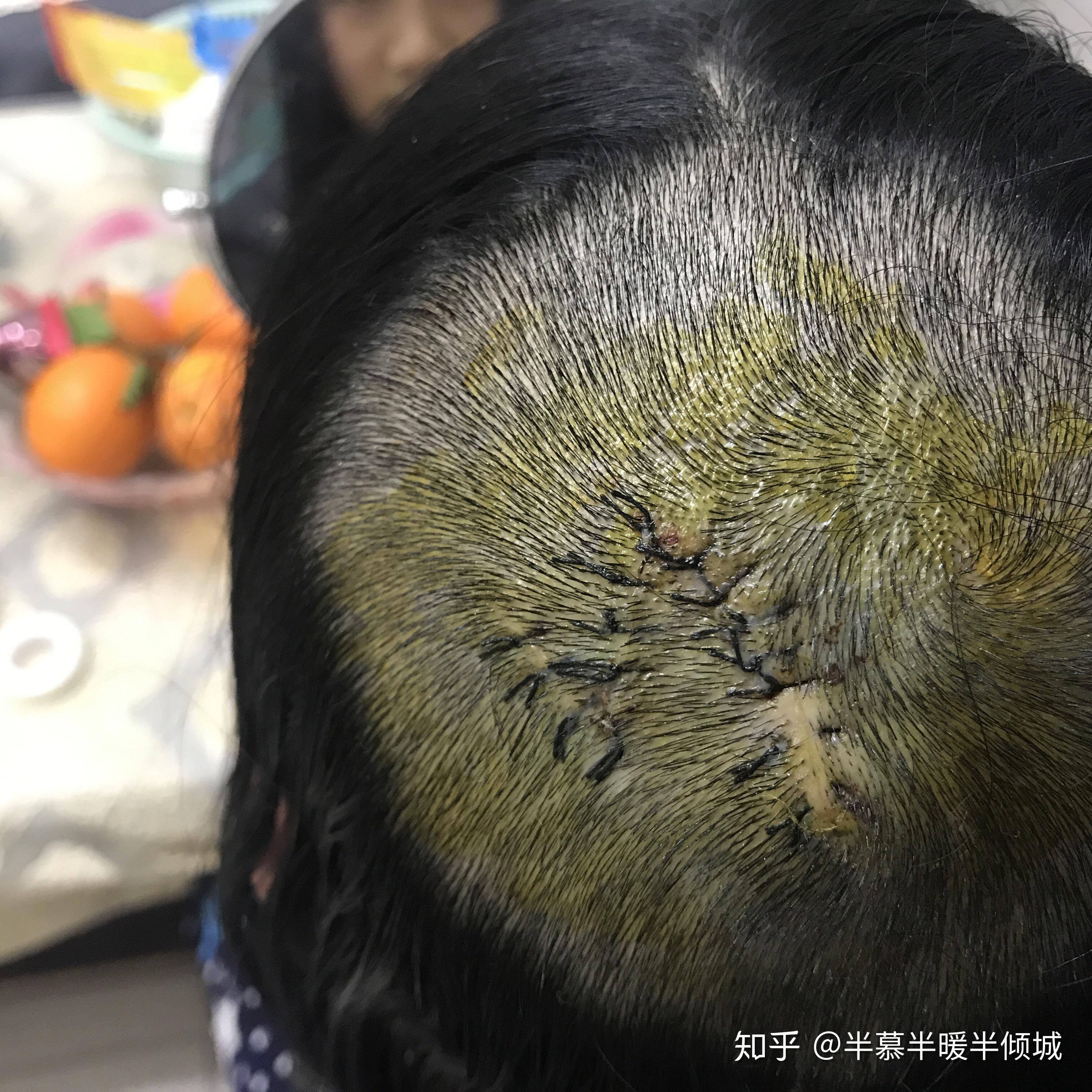 给大家分享一下皮脂腺痣治疗过程