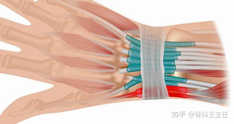 腱鞘炎還是腕管綜合徵分不清可能要做手術