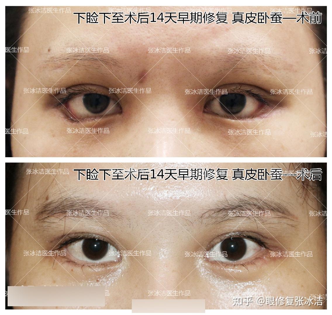 张冰洁自体真皮卧蚕丨真皮卧蚕对眼睛气质以及眼修复的效果综述