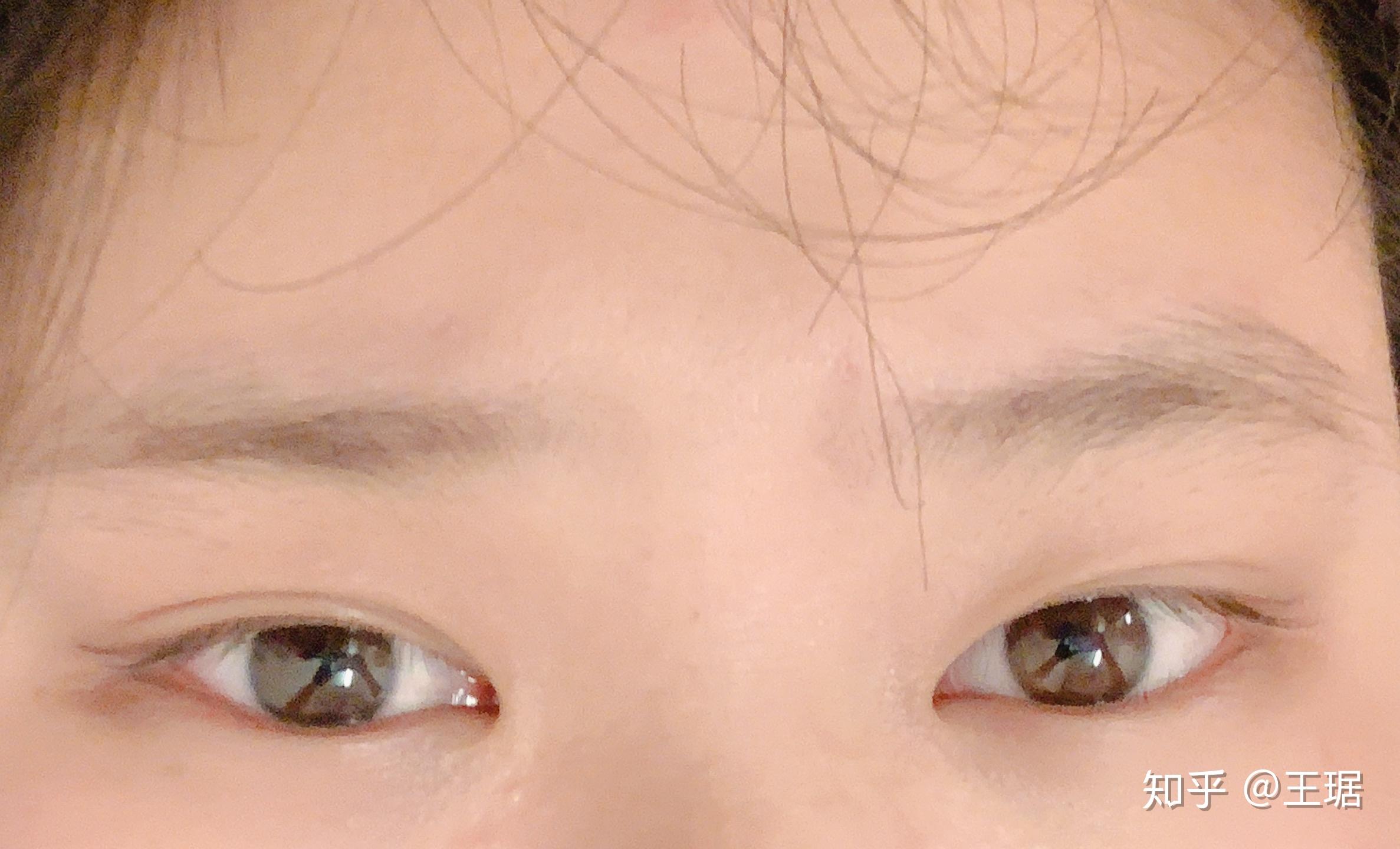 重度の一重瞼による眼瞼下垂症と横径が小さいのは眼裂狭小症といいますが、治れば普通に見られます。 - ドクター森川ブログ