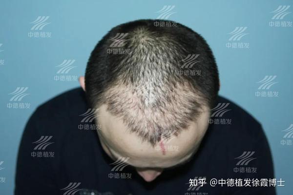 植发失败了怎么办？经典案例分析为您指明前路！ - 知乎