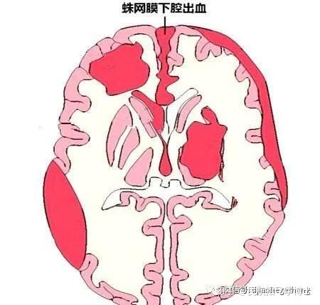 现役飞行员颅脑损伤系列十二:外伤性蛛网膜下腔出血