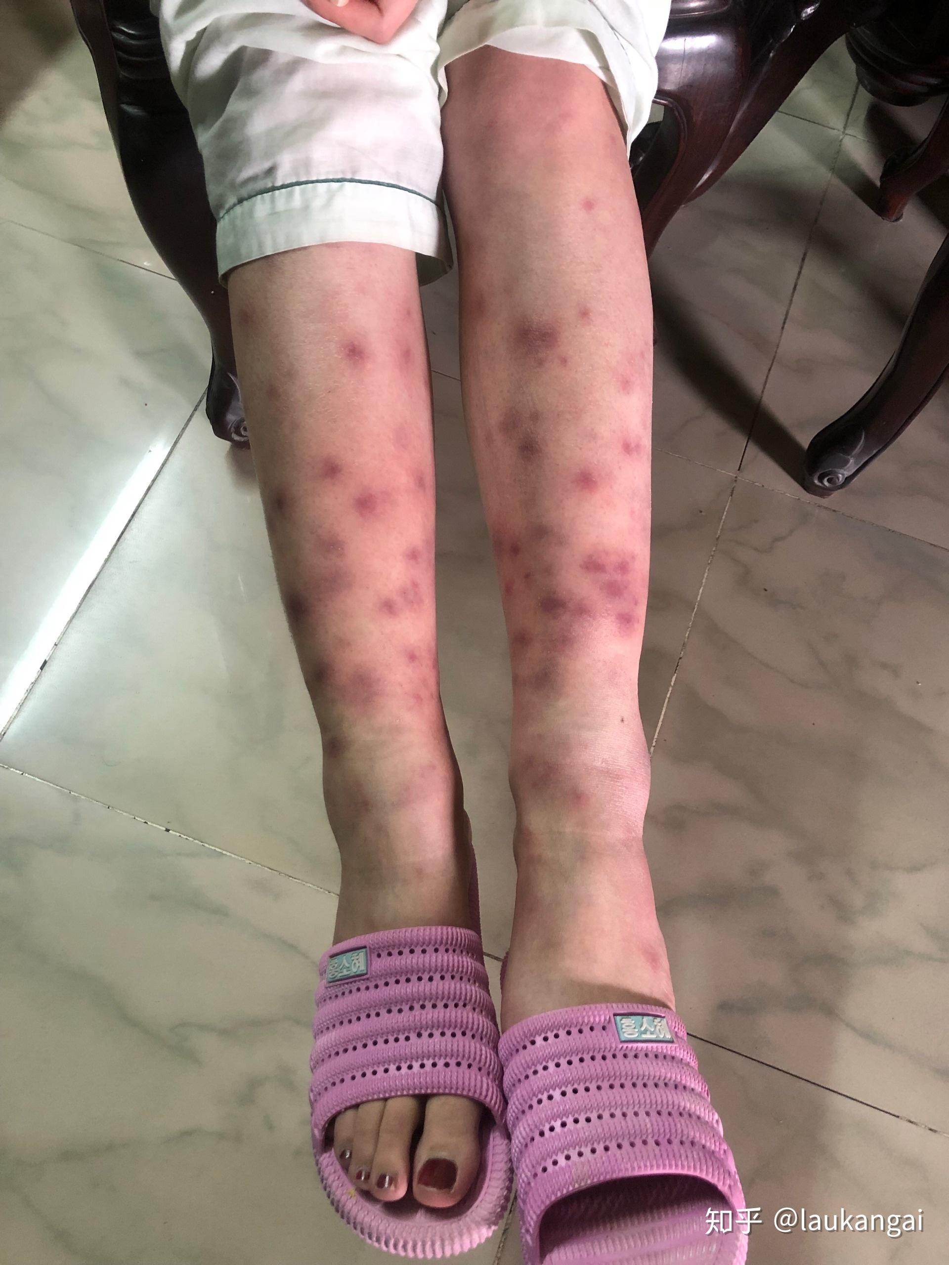 得过结节性红斑的人过来交流下? - 知乎