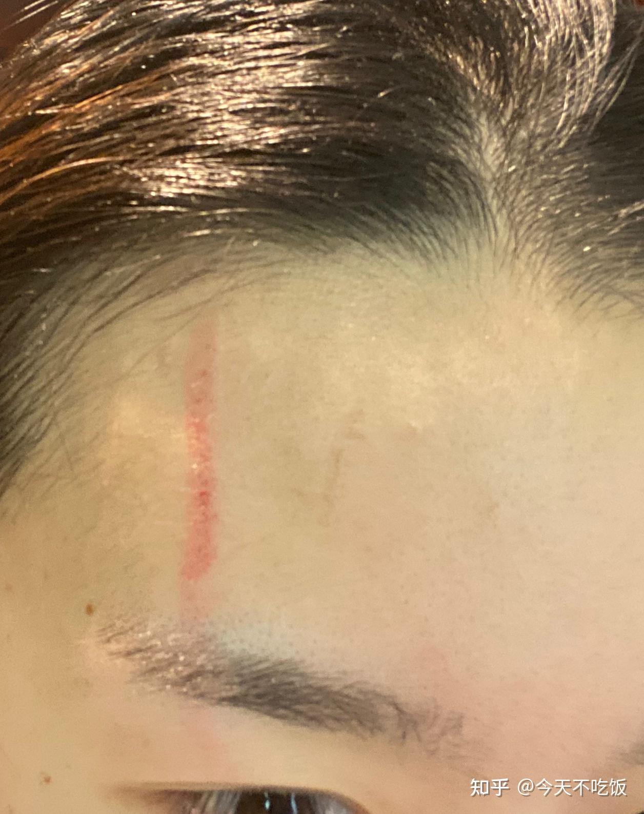 打咯,上次被狂踢狂打的时候,不敢随便动上半身,就是会从前胸疼到后背
