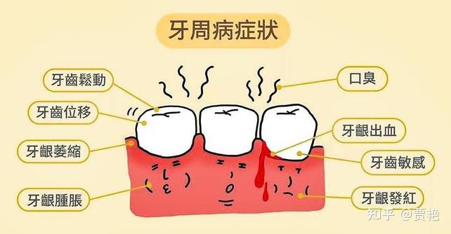 科普丨牙龈炎与牙周炎有什么区别? - 知乎