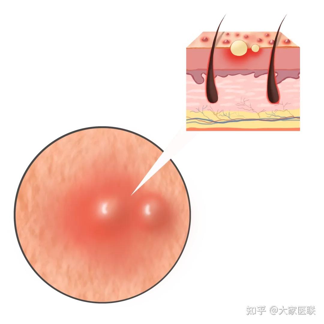 糖尿病患者如果出現皮膚乾燥脫屑,皸裂瘙癢,皮膚變色,局部水皰等症狀.