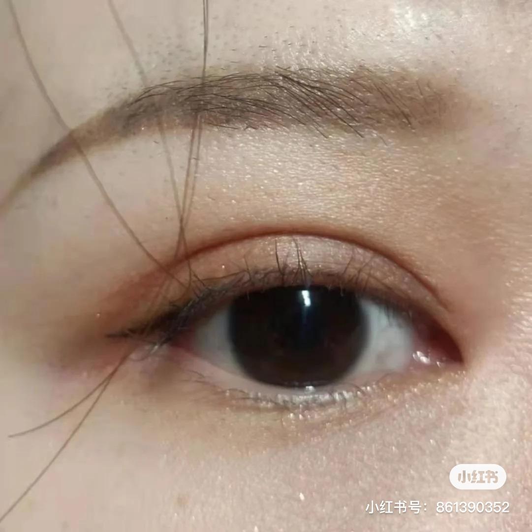 开眼角有必要做吗 v2-63760b3722a1f2f4422cb4611c79ebdc_1440w.jpg?source=172ae18b