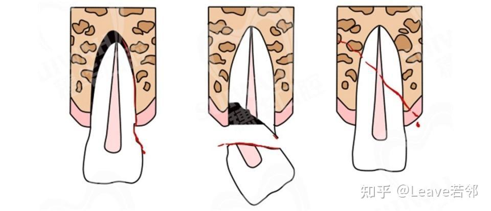 牙齿敏感和疼痛楔状缺损可能导致牙齿表面的保护层受损,使牙齿变得