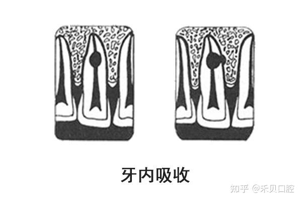 牙根吸收是什么？ - 知乎