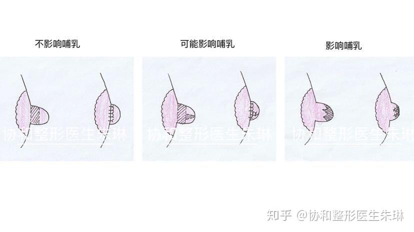 有的手术方式对哺乳功能可能有影响,也有的手术方法会完全破坏哺乳