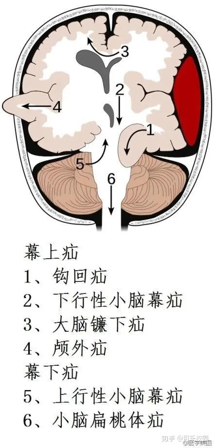 幾種類型腦出血的ct表現16.脊神經17.腰穿的局部解剖18.顱頂層次19.