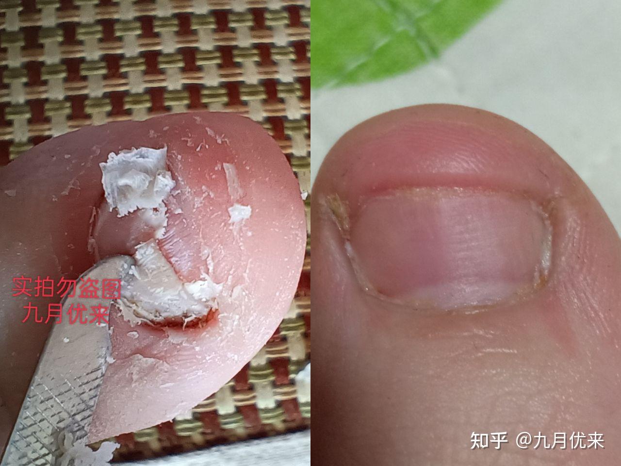 想要彻底告别灰指甲,必须脱掉病甲露出甲床,然后杀灭甲床下的真菌,灰指甲才能康复,6年的宝藏经验分享