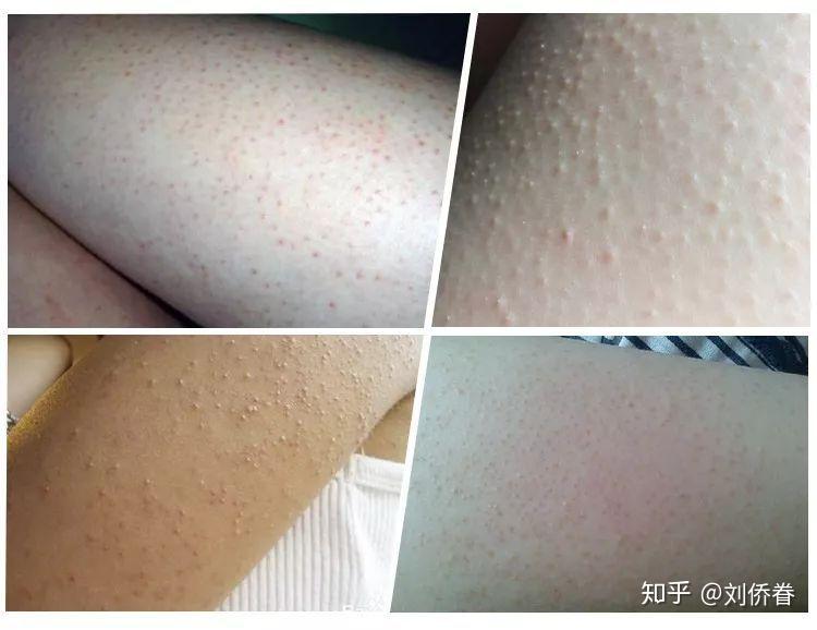 鸡皮肤怎么消除最有效知乎的简单介绍