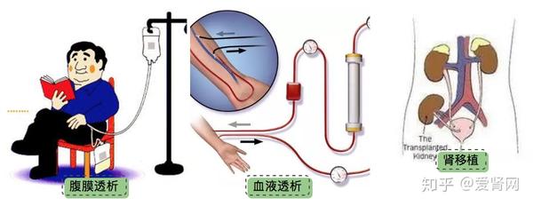 腹透和血透哪种更好图片