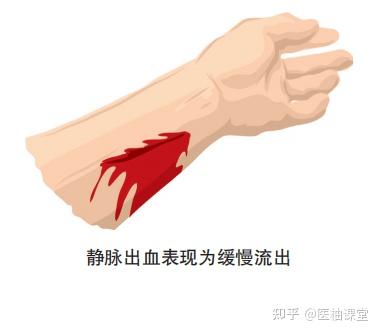 常见外伤出血患者的止血方法汇总 - 知乎
