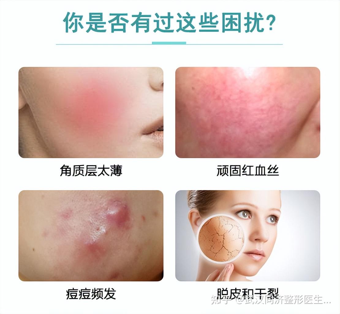 舒敏之星究竟是什么?它可以解决哪些皮肤问题? - 知乎