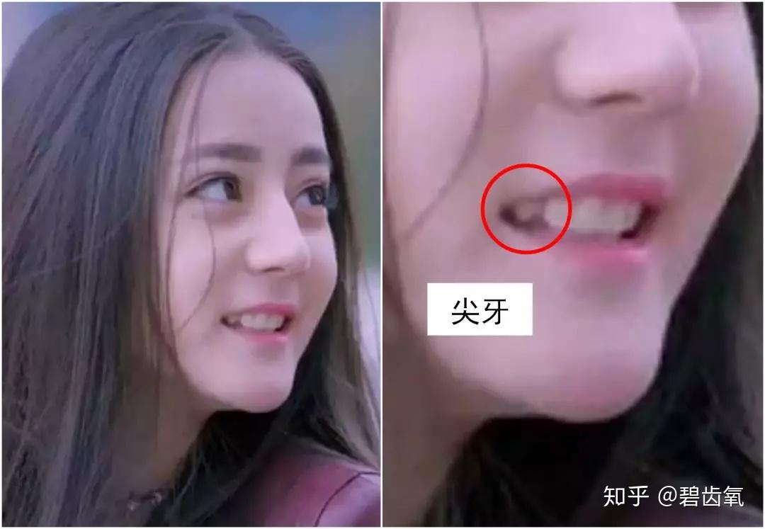 烤瓷牙选手热巴代言美白牙膏?黑人,你认真的吗