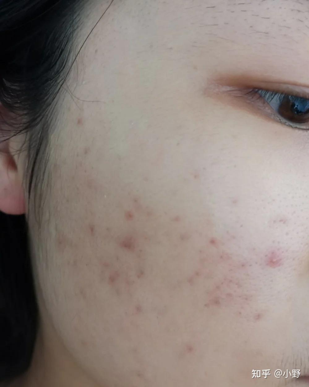 陈年痘印一两年的那种怎么去