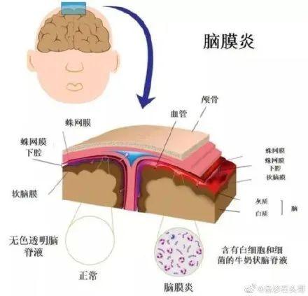 主要表現症狀有發熱,嘔吐,意識障礙,頸項強直等症狀.