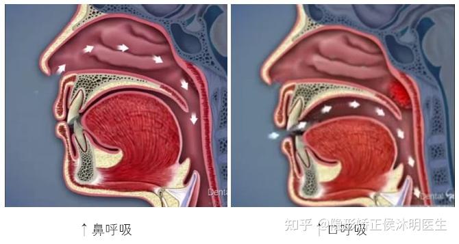 因此家长要知道,单纯的张口呼吸不一定会出现腺样体面容,因为腺样体