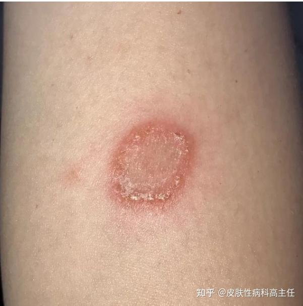 皮肤真菌感染怎么办?