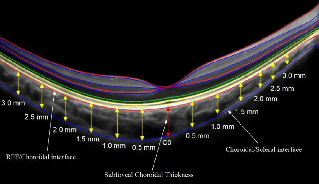 近视与脉络膜厚度和脉络膜毛细血管密度的关系