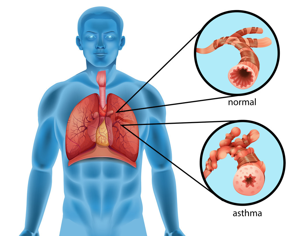 哮喘患者为什么要做哮喘药物基因检测？
