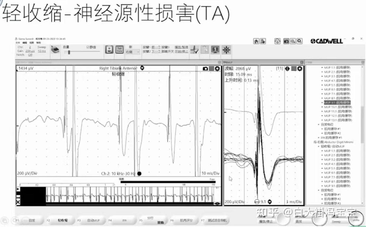 神经肌电图多少钱图片