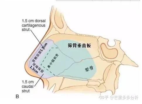 很多医生都不建议做鼻中隔隆鼻手术,这到底是为什么呢? - 知乎