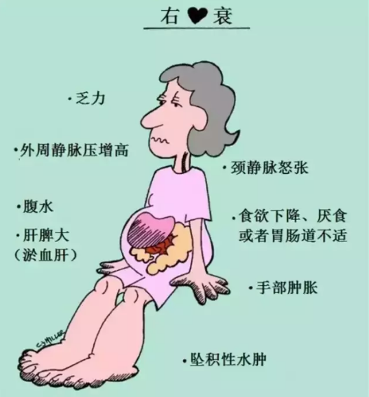 临床笔记左心衰vs右心衰这些体征你都知道吗