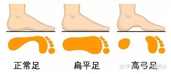 “宽厚”罗马脚、“美人”希腊脚，你知道自己是哪种脚型吗？搞懂这个穿鞋才舒服！ - 知乎