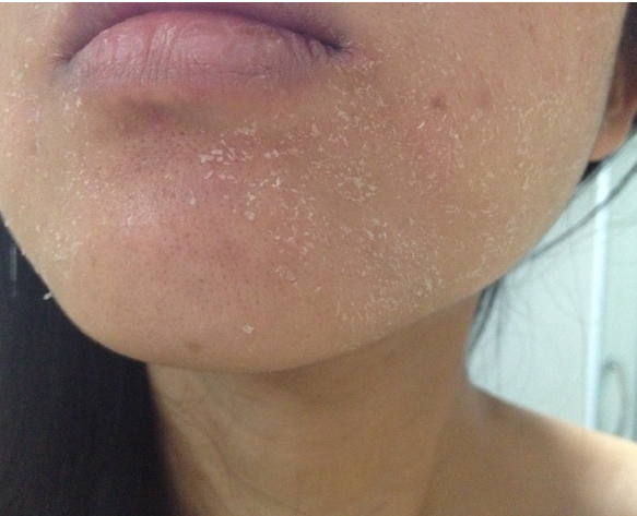 换季皮肤过敏如何快速修护